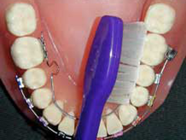 Brushing with braces