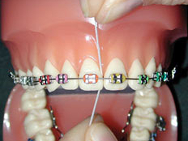 Flossing with braces